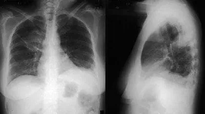 Сutaneous vasculitis: classification, diagnosis and differential diagnosis  (part 1) - Khairutdinov - Vestnik dermatologii i venerologii