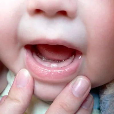 Коренные зубы у детей - прорезывание и симптомы роста