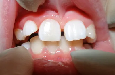 Прорезывание зубов у детей, что нужно знать родителям? ← Аптечка малыша —  Россия