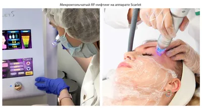 Rf-, сторис косметолог, stories cosmetology | Лицо, Косметолог, Косметология