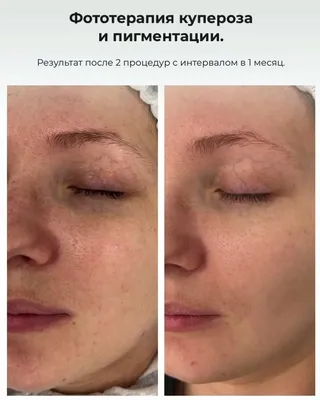 Розацеа: особенности ухода - cosmopro-shop.ru