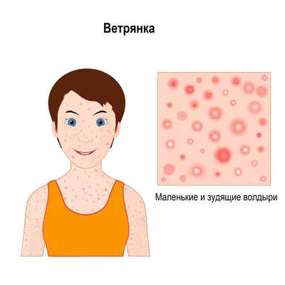 Заразные болезни, которые могут убить | Дракон старой гвардии | Дзен