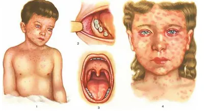 Экзантема - причины появления, симптомы заболевания, диагностика и способы  лечения