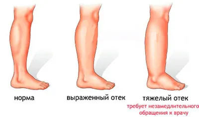 Инфекция рожи бактериальная под ногой кожи постарела люди на белой  предпосылке Стоковое Фото - изображение насчитывающей диффузно,  заболевание: 152843782