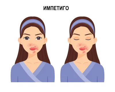 Стрептодермия у детей — формы, симптомы и методы лечения заболевания