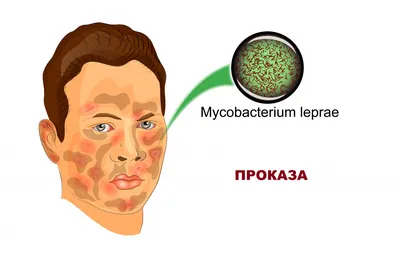 Что такое розацеа кожи: причины, симптомы, классификация, как лечить |  Лазерсвiт