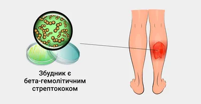 Рожистое воспаление (рожа): лечение, симптомы и диагностика