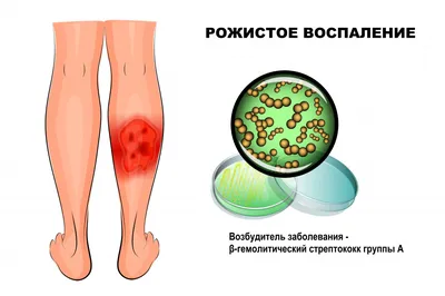 Рожа, или рожистое воспаление - причины появления, симптомы заболевания,  диагностика и способы лечения