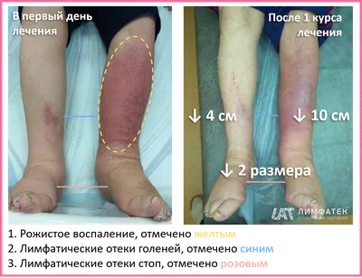 Рожа - заболевание, о котором должен знать каждый пациент с отеком. Большой  гайд по болезни. - Доктор Ивашков В.Ю.