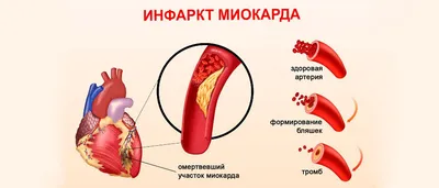 Рубец на сердце после инфаркта фото