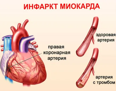 Постинфарктный кардиосклероз, проще говоря - рубец ... - Наша Чудесная  Планета: Наука и факты, №982631313 | Фотострана – cайт знакомств,  развлечений и игр