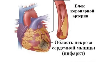 Лечение инфаркта миокарда в Екатеринбурге - Новая Больница