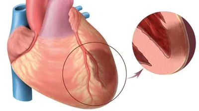 Лечение инфаркта миокарда в Екатеринбурге - Новая Больница
