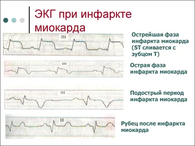 Плановое и экстренное коронарное шунтирование в Израиле : Armedical