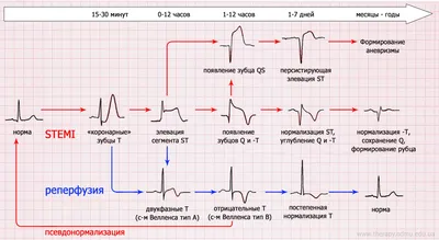 STEMI - инфаркт миокарда с элевацией ST