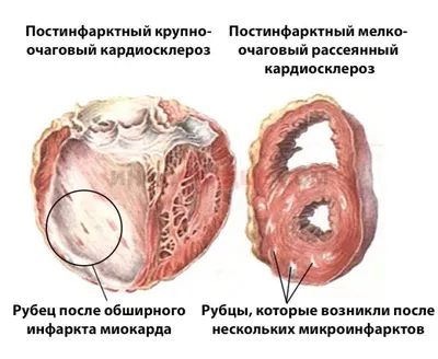 Реабилитация после операции по удалению грыжи межпозвонкового диска.  Восстановительное лечение – Отделение вертебрологии НКЦ №2 (ЦКБ РАН)