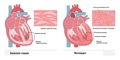 Может ли сердце полностью восстановиться после инфаркта и сколько ему нужно  на это времени | Dr. Kichinsky. О здоровье и медицине | Дзен