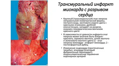 Вот такой рубец!»: что нужно знать об инфаркте миокарда?