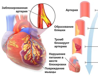 Алкоголь и инфаркт миокарда.