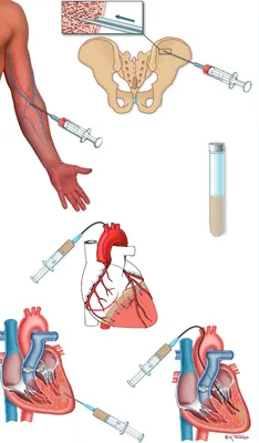 Semi-Minimal Invasive Method to Induce Myocardial Infarction in Rats and  the Assessment of Cardiac Function by an Isolated Working Heart System |  Protocol (Translated to Russian)