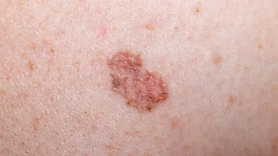 melanoma unit