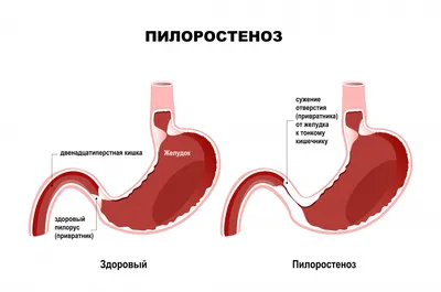 Рвота с кровью после алкоголя: почему рвет кровью