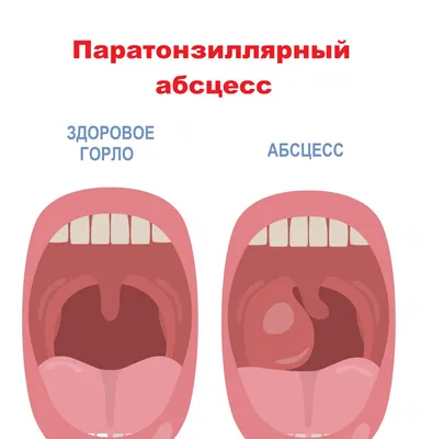 Тонзиллит консультация лечение в клинике Санкт-Петербург ID-CLINIC