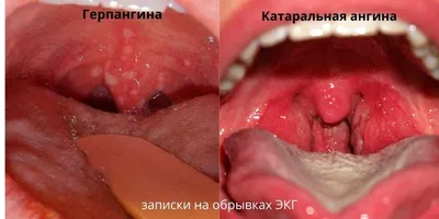 Белые точки на гландах у детей: симптомы и причины появления. Лечение  тонзиллита — Статьи — ОН КЛИНИК Бейби