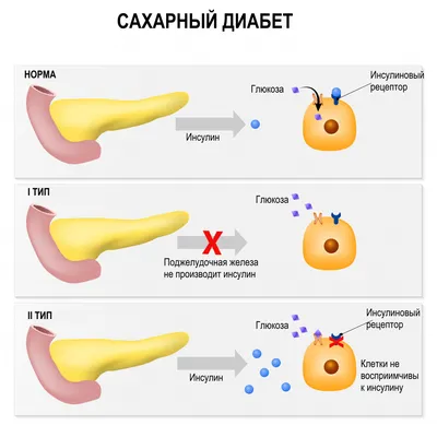 Плакат \"Сахарный диабет\" (арт.ШКМ-09) купить в Москве с доставкой: выгодные  цены в интернет-магазине АзбукаДекор