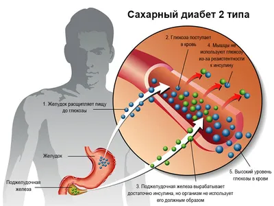 Лишний вес при сахарном диабете - Доктор Виктор Тетюк