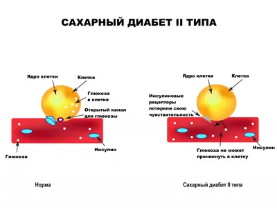 Диабетическая ретинопатия: проблемы со зрением, связанные с сахарным  диабетом