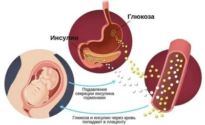 Сахарный диабет – болезнь образа жизни!