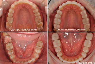 Красивая и естественная улыбка после протезирования зубов керамикой