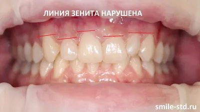 Как виниры исправили асимметрию улыбки у девушки – клиника Smile STD, Москва