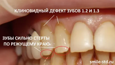 Установка виниров и коронок женщинам после 50 лет. Клиника Smile STD в  Измайлово