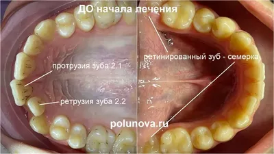 Как лечить скученность зубов в разном возрасте | Клиника Ортодонтика, Москва