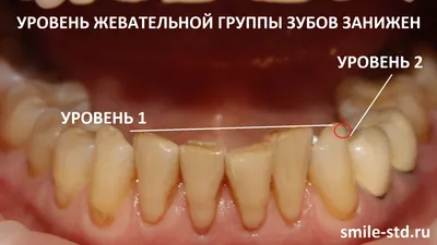 Установка виниров и коронок женщинам после 50 лет. Клиника Smile STD в  Измайлово