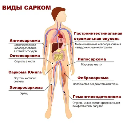 Саркома - симптомы, фото, признаки, лечение, прогноз выживаемости