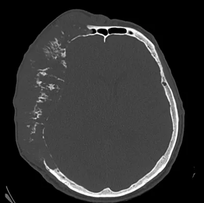 Саркома онкологии косточки Mri бедровая Стоковое Изображение - изображение  насчитывающей черный, ткани: 97863143