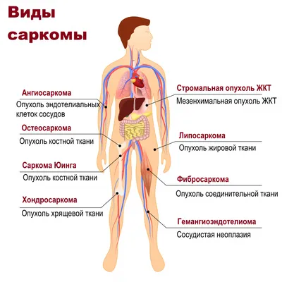 Саркома Капоши | форум hiv.plus