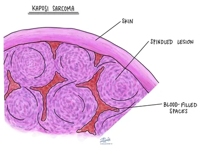 PDF) СЛУЧАЙ САРКОМЫ КАПОШИ У ДЕВЯТИМЕСЯЧНОГО ВИЧ-ИНФИЦИРОВАННОГО РЕБЕНКА