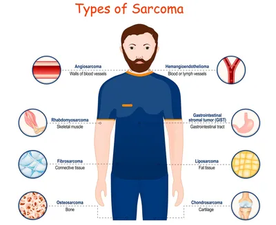 Классификация сарком мягких тканей — Онкопедия клиники Нордвест, Германия