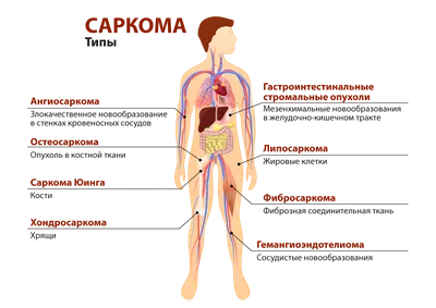 Саркома -