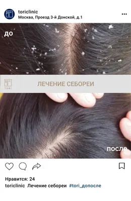 Лечение себорейного дерматита (себореи) в Киеве — Derma.ua