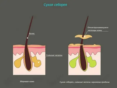 Себорейный дерматит на коже и голове - причины, симптомы, диагностика,  лечение