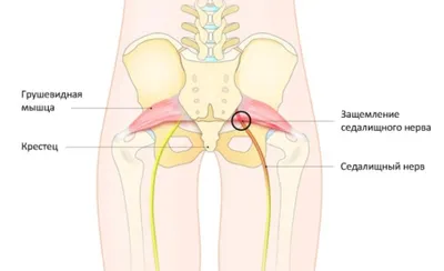 Как лечить воспаление седалищного нерва | «ЗдравКлиник»