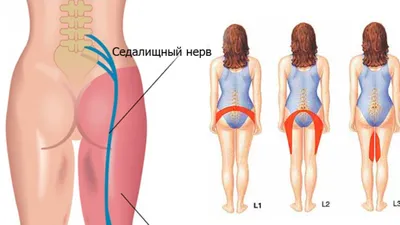 Болит седалищный нерв. Что делать? | медицинские товары и медтехника в  магазине Ортосалон