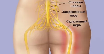 8 простых упражнений, которые помогут избавиться от защемления седалищного  нерва! | Упражнения, Лечение спины, Журнал о здоровье