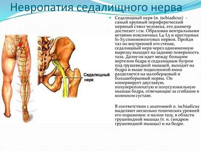 Как лечить воспаленный седалищный нерв в домашних условиях.