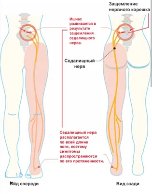 Воспаление седалищного нерва или ишиас. Что такое ишалгия? - Медицинская  клиника \"Атлант\"